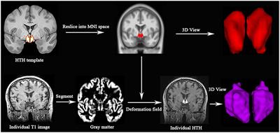 Volume of Hypothalamus as a Diagnostic Biomarker of Chronic Migraine